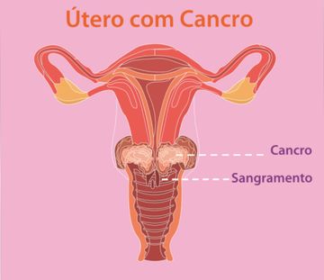 utero-com-cancro.width-360